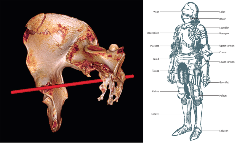 Illustration for article titled Nuevas imágenes revelan las heridas que mataron al rey Ricardo III